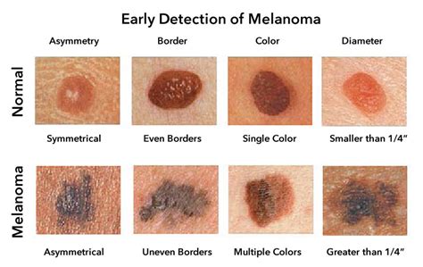 皮膚癌|Skin Cancer: Symptoms, Types & Treatment